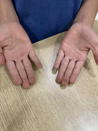9歲小學(xué)生長(zhǎng)期拍煙卡，手部粗糙長(zhǎng)繭。受訪者供圖